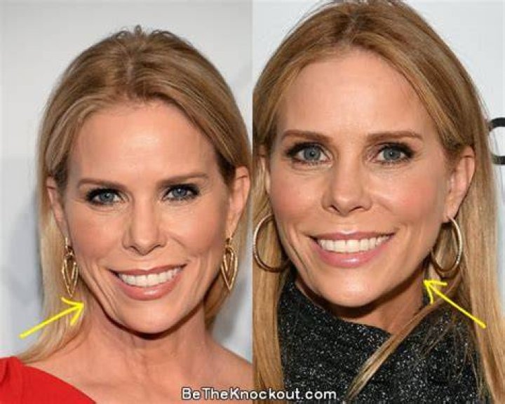 cheryl hines plastic surgery