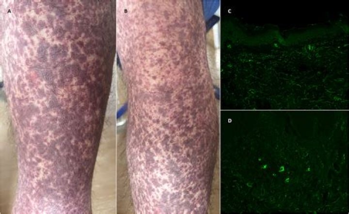 Cutaneous Clues Linked to COVID-19 Coagulation Risk